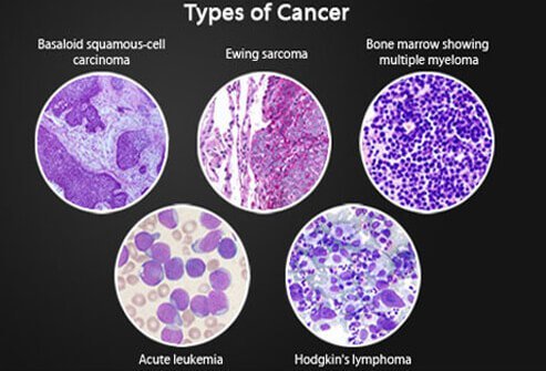 Yang Perlu Diketahui Mengenai Kanker Berdasarkan Klasifikasi